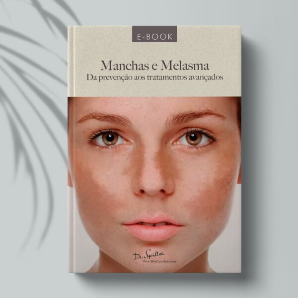 E-book Manchas e Melasma - Da prevenção aos tratamentos avançados
