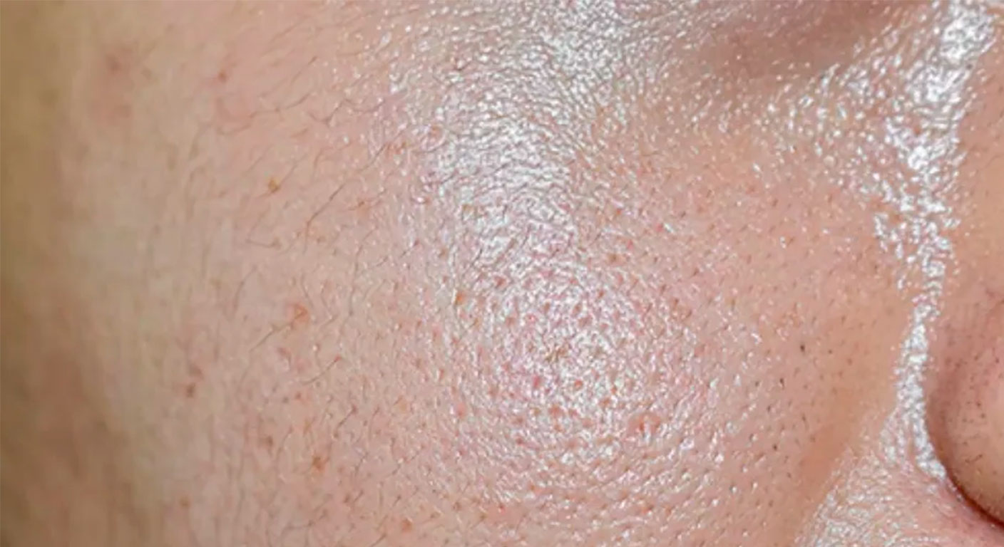 Pele oleosa após o verão: como controlar a produção de sebo e fechar os poros