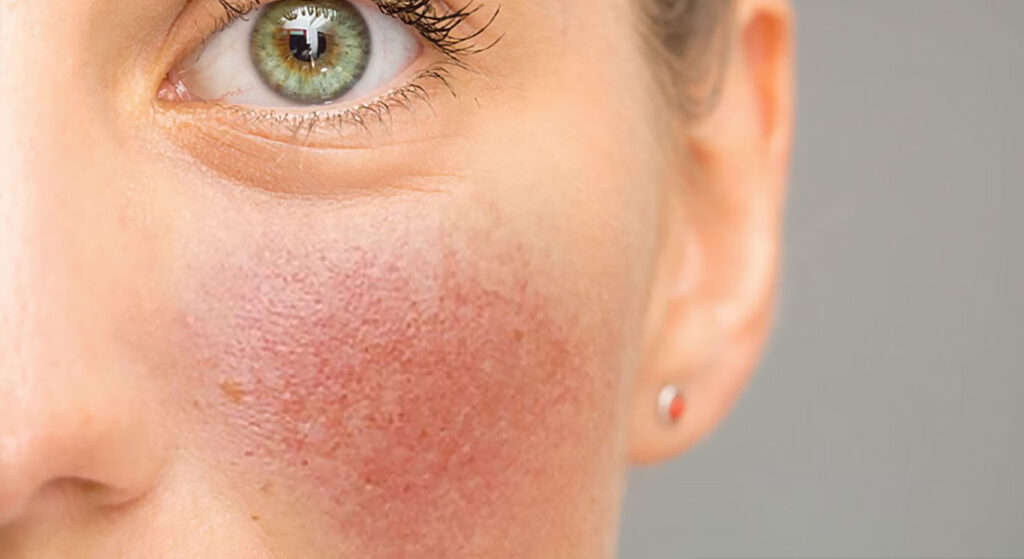 rosacea-tratamento-profissional-dr-spiller