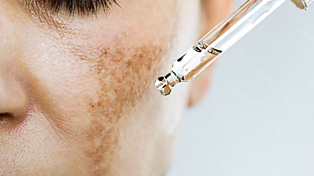 Melasma Tratamento: Como Controlar, Clarear e Prevenir as Manchas no Rosto